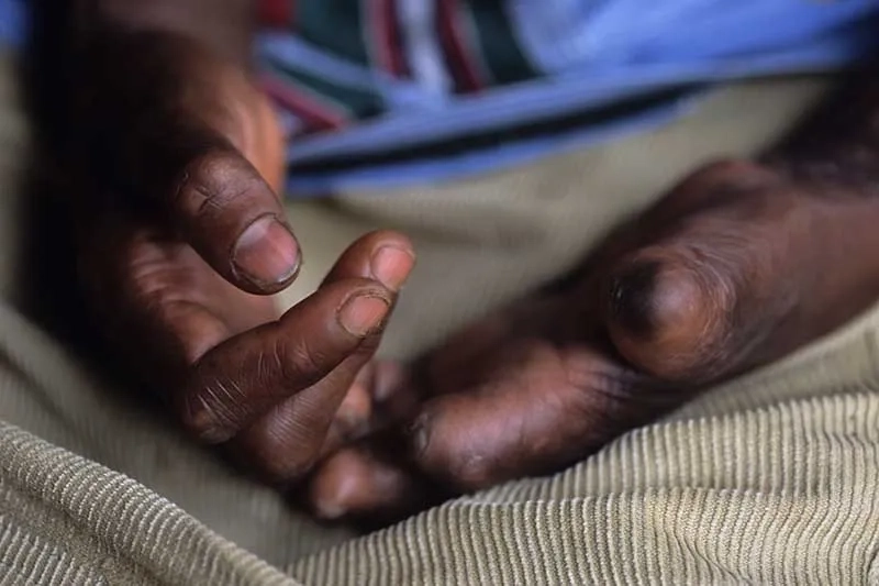 Recognizing the early signs of leprosy