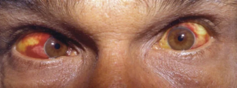 Learning if is leptospirosis contagious between pets and people