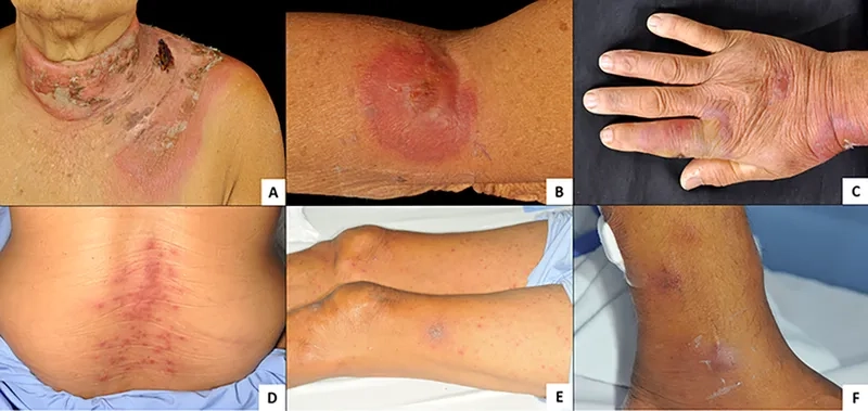Microscopic view of acute myeloid leukemia (AML)