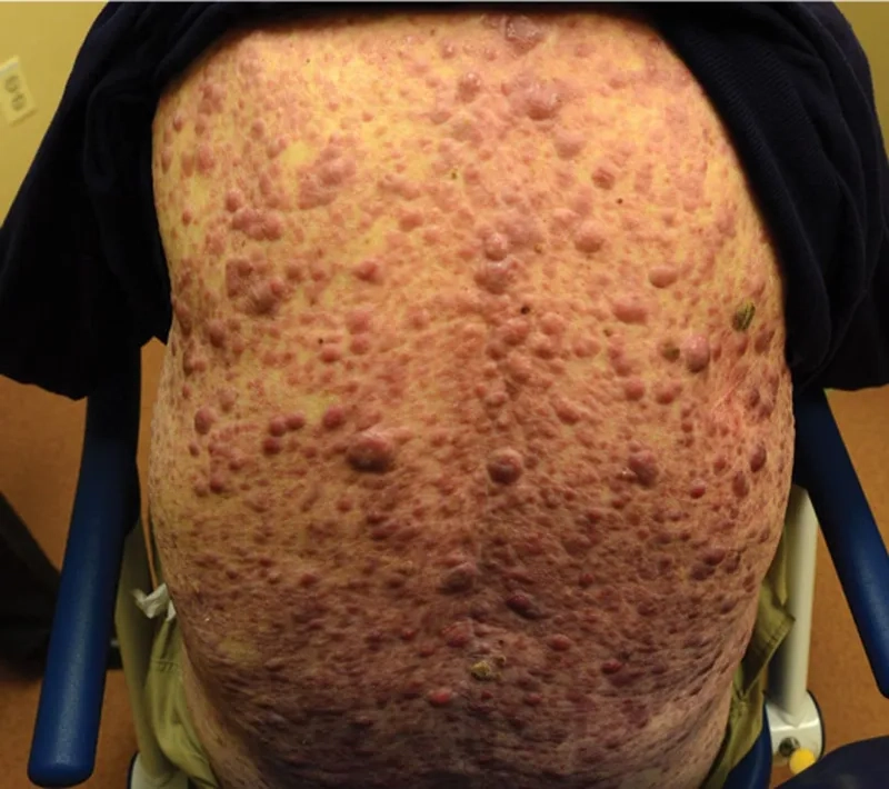 Cell changes in acute lymphoblastic leukemia (ALL)