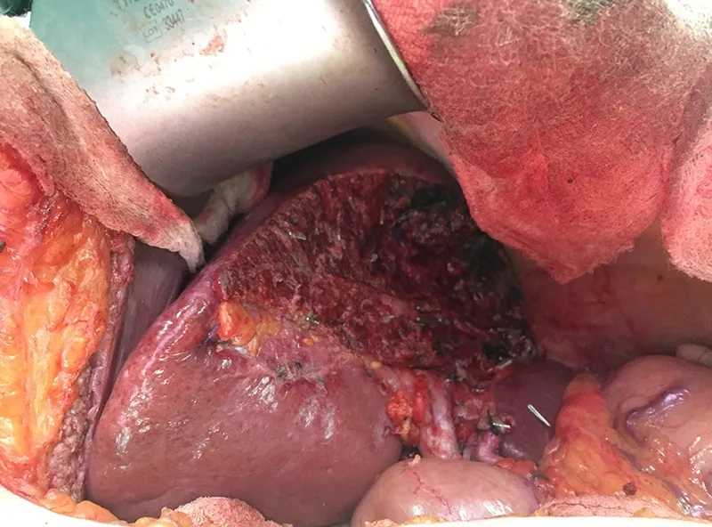 Signs of liver cancer and early health indicators