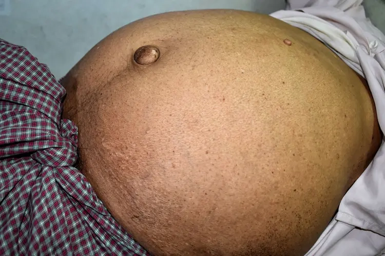 Liver cancer symptoms and clinical warning signs