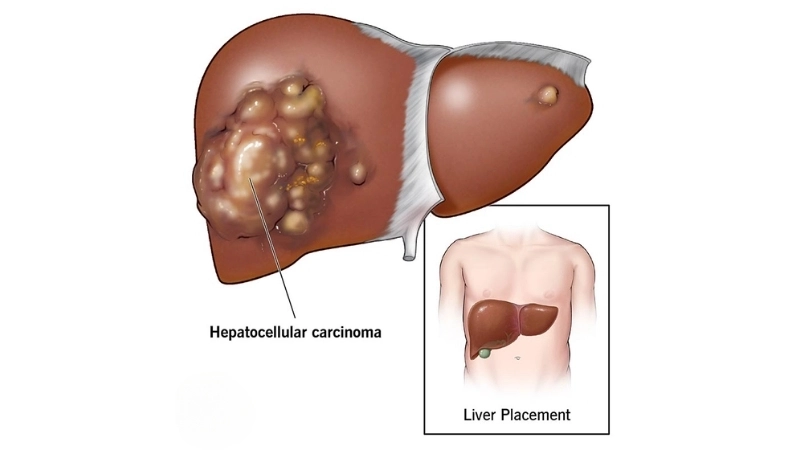 Liver cancer early signs in hepatocellular carcinoma