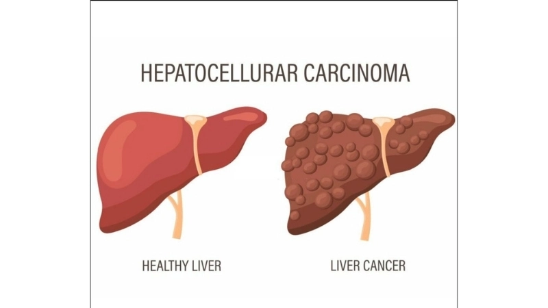 Hepatocellular carcinoma liver cancer symptoms guide