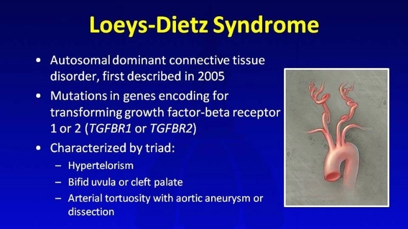 Medical approach to Loeys-Dietz syndrome diagnosis