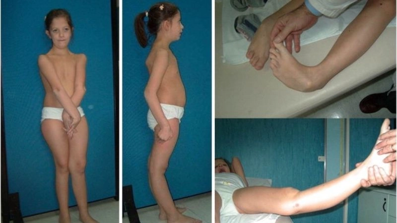 Key comparison Loeys-Dietz syndrome vs Marfan syndrome