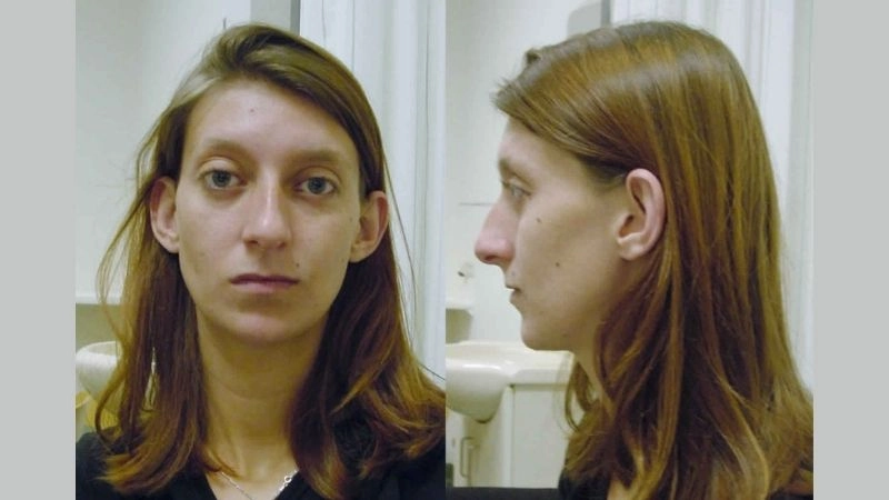 Prognosis and Loeys-Dietz syndrome life expectancy