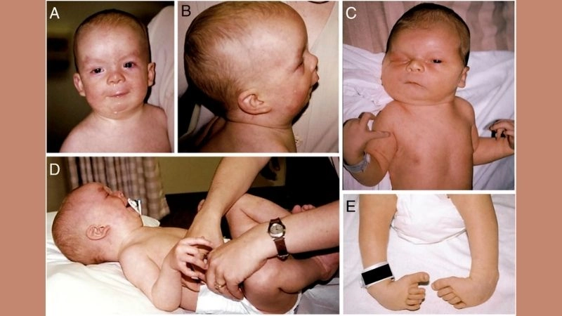 Classification explained for Loeys-Dietz syndrome types