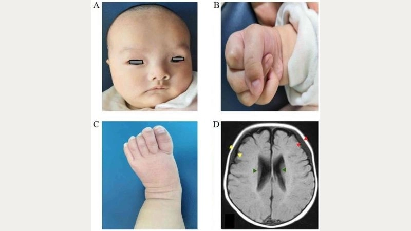 Cardiovascular risks in Loeys-Dietz syndrome heart complications
