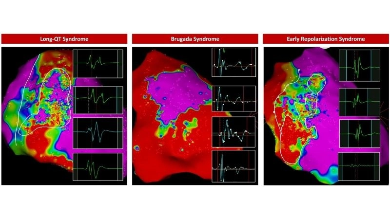 Jervell And Lange-Nielsen Syndrome rare inherited form