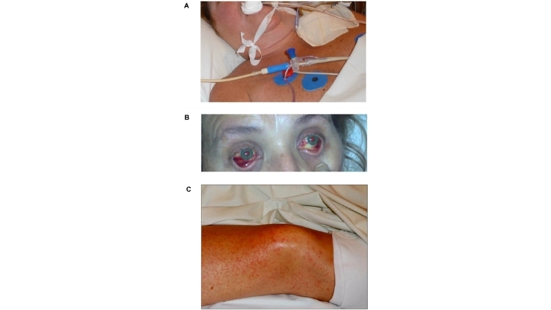 Lujo hemorrhagic fever symptoms guide