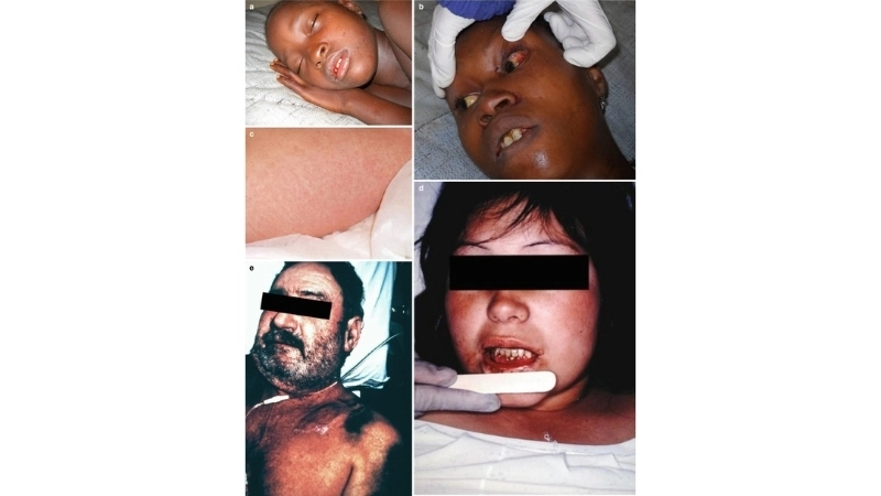 Understand Lujo hemorrhagic fever transmission risk