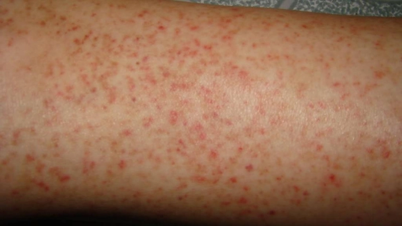 Track Lujo hemorrhagic fever outbreak updates