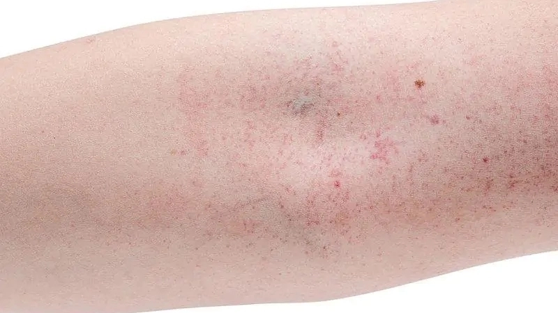 Get insights into Lujo hemorrhagic fever diagnosis