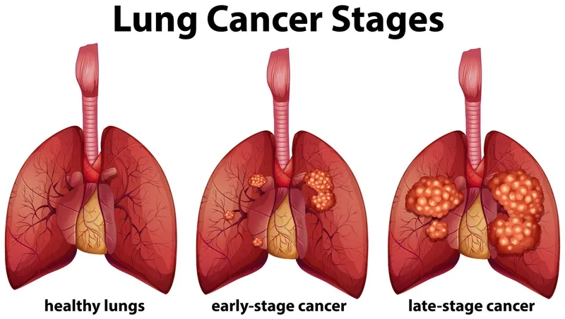 An infographic of common lung cancer symptoms