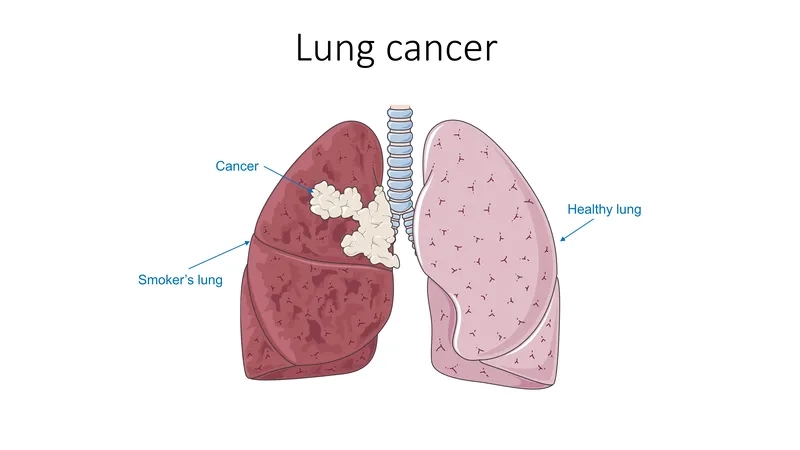 Infographic of the primary causes of lung cancer