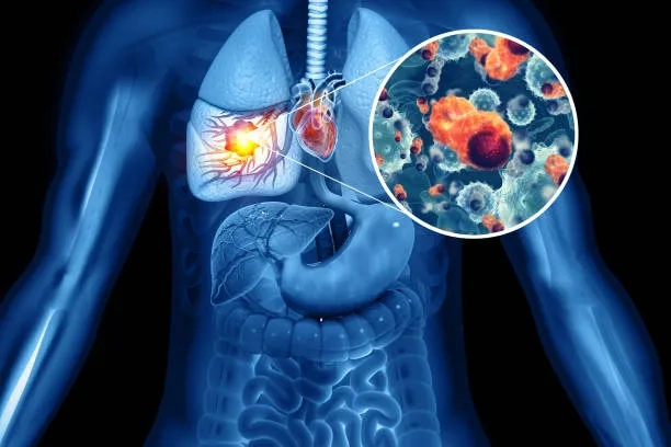 Diagram explaining what is lung cancer