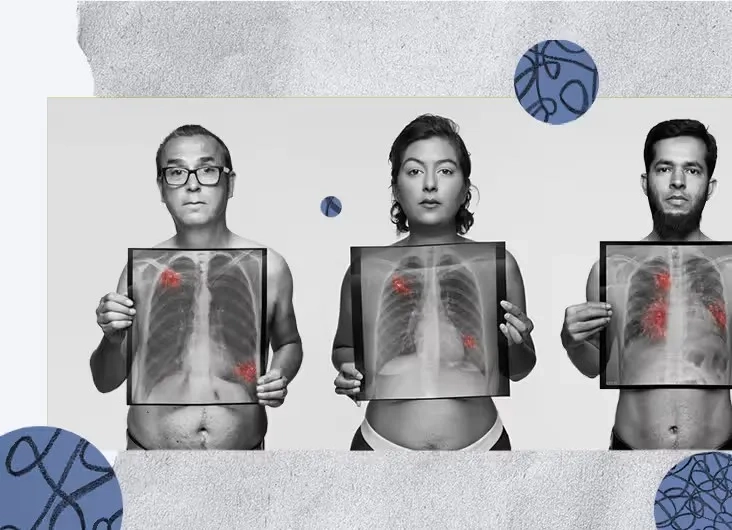 Microscopic image of non-small cell lung cancer