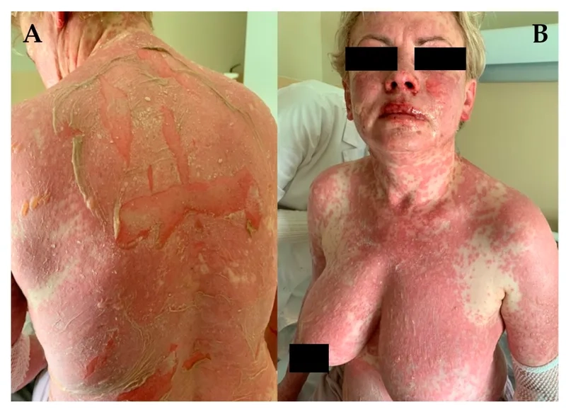 Comparing different types of lupus