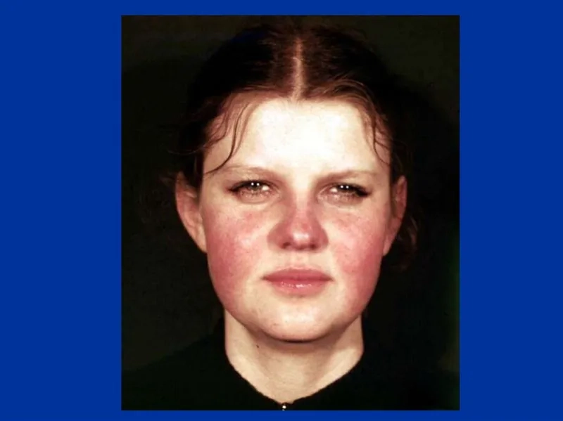 Signs of a systemic lupus flare