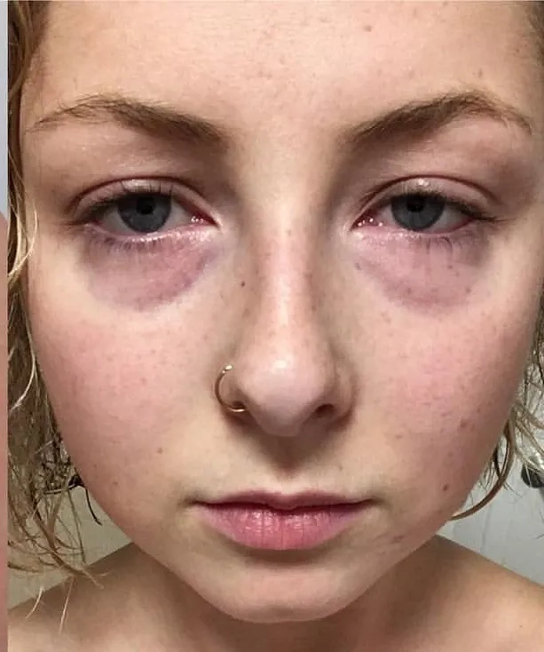 An illustration of lupus nephritis