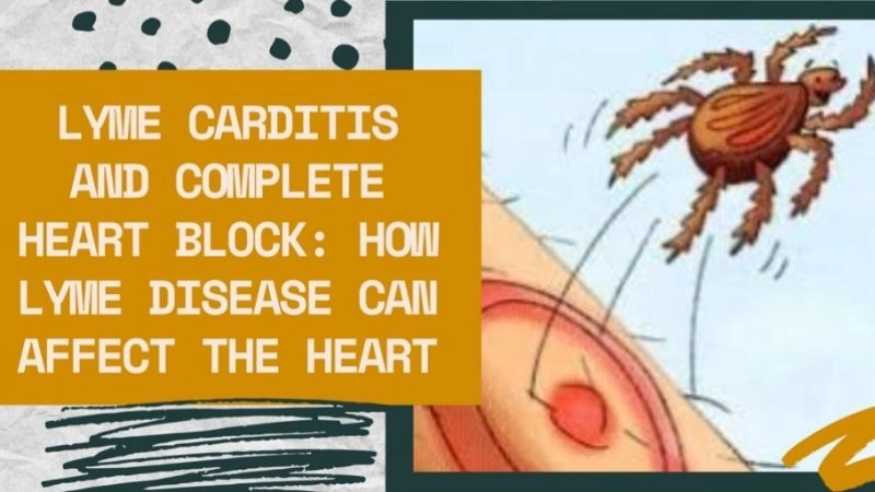 Lyme carditis treatment medical care for cardiac infection