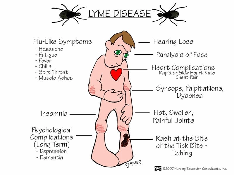 Photos of Lyme disease rash stages