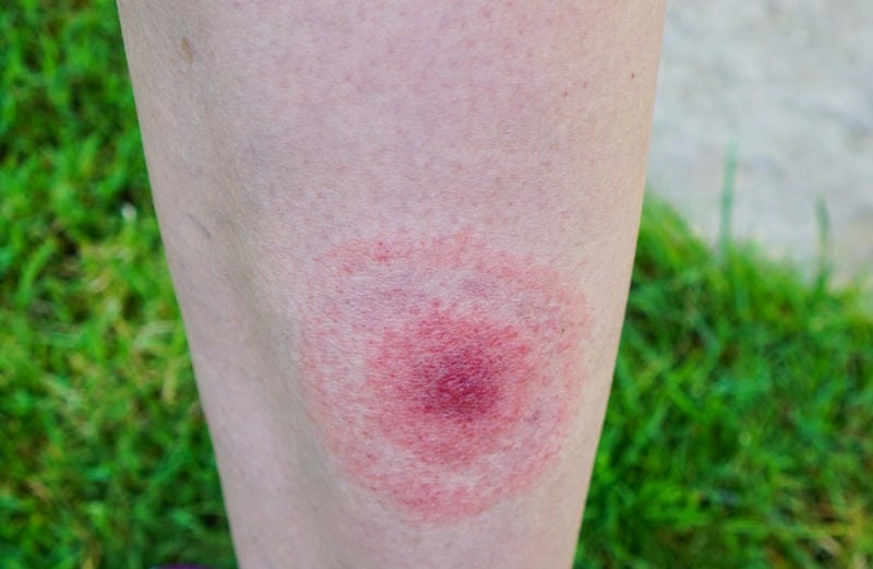 Recognizing chronic Lyme disease symptoms
