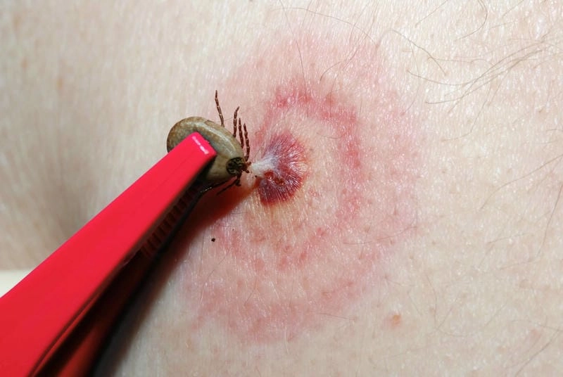 Understanding if Lyme disease is contagious