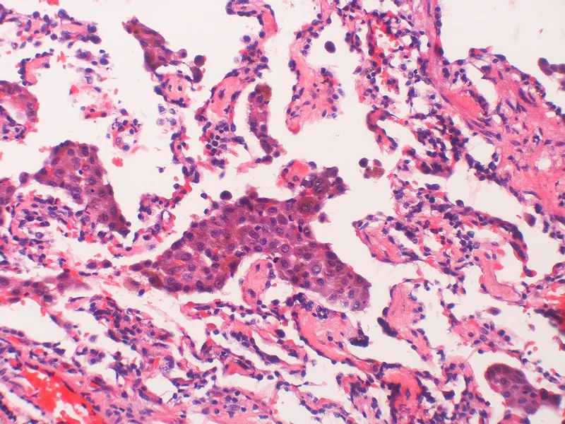Early LAM symptoms in affected patients