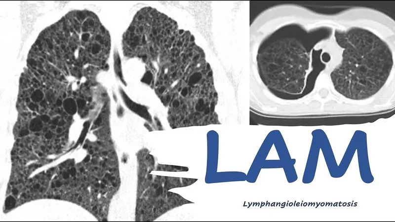 LAM lung disease treatment options shown