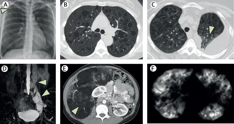 List of rare lung diseases for awareness