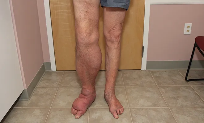 Recognizing the early lymphedema symptoms