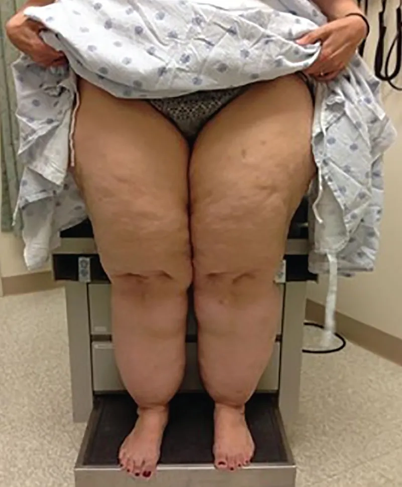 A clear explanation of what is lymphedema