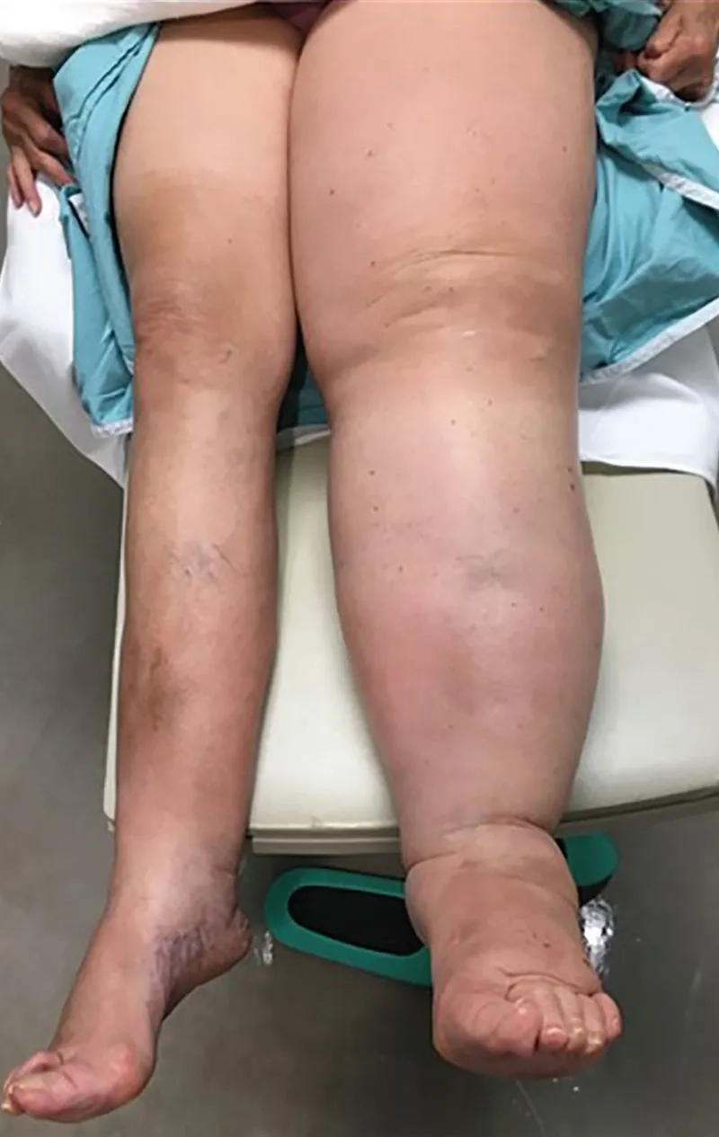 Comparing the differences of lymphedema vs edema