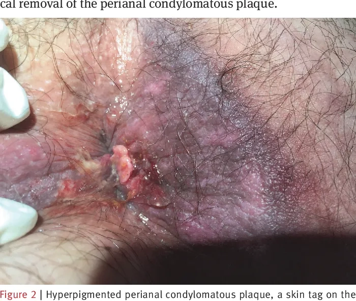 A laboratory test for the diagnosis of LGV