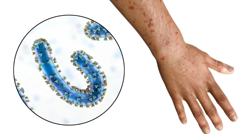 Track Marburg virus disease outbreak updates