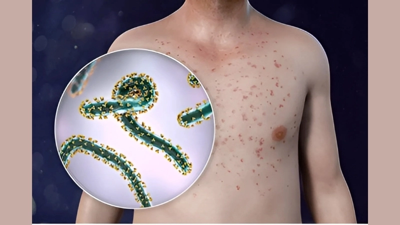 A map showing a Marburg virus outbreak update