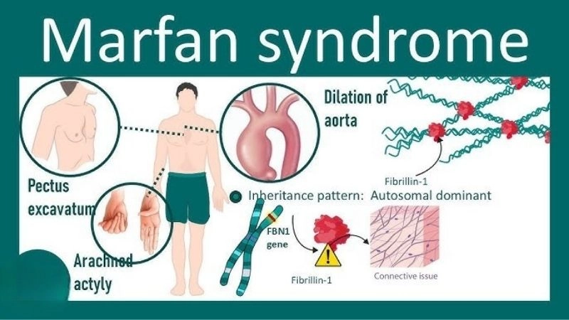 Clinical insight into Marfan syndrome symptoms