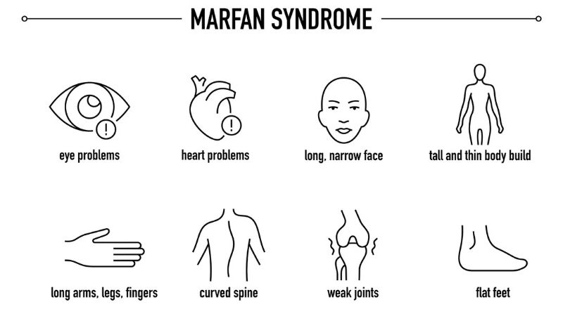 Medical clarity for Marfan syndrome diagnosis steps