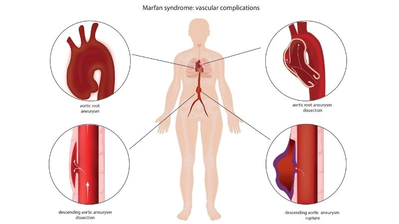Key facts answering what is Marfan syndrome