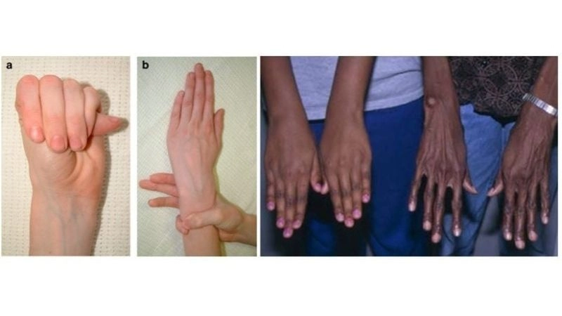 Risk factors of Marfan syndrome and heart problems