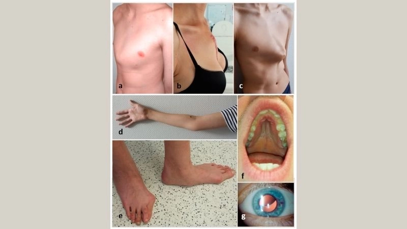 Genetic insights through Marfan syndrome genetic testing