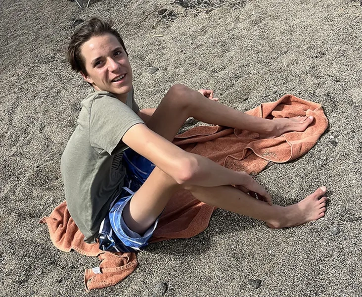 Common physical traits of Marfan syndrome