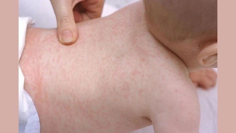 Discover Mayaro Virus Fever treatment options