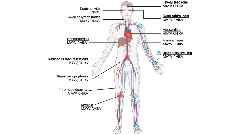 Latest Mayaro Virus Fever outbreak updates