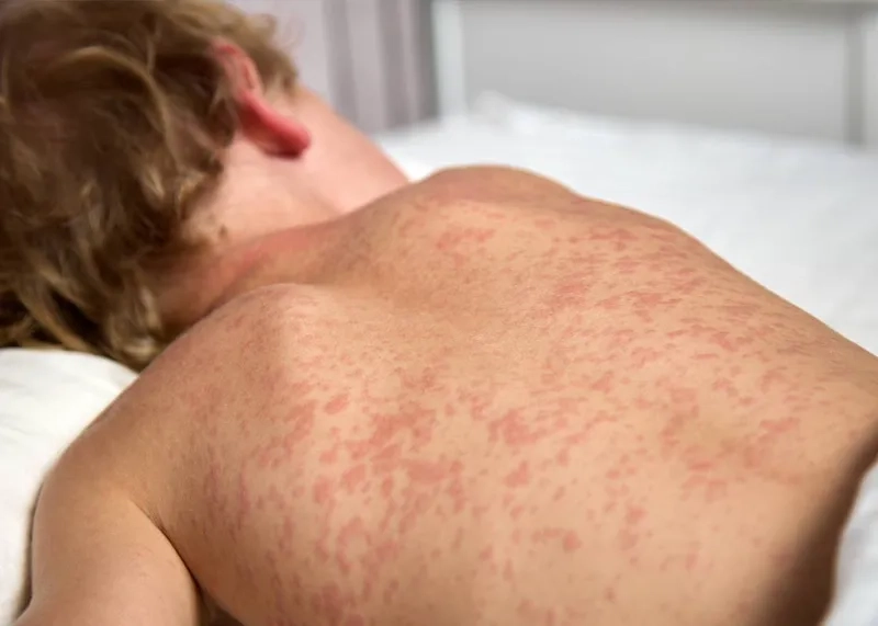 A close-up view of the red rash of measles on skin