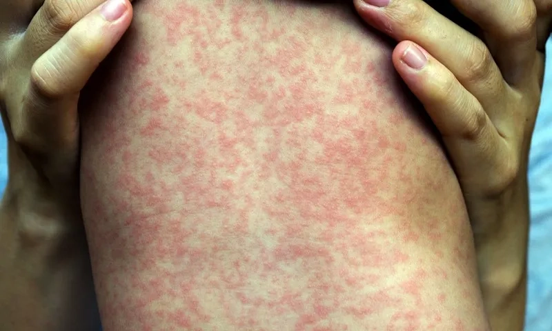 Child protected from measles with vaccine administration