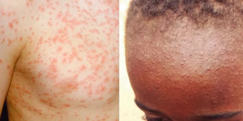 A healthcare professional preparing the measles vaccine