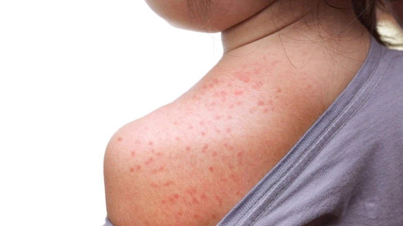 Measles (Rubeola) rubeola symptoms explained